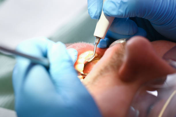 Best Knocked-Out Tooth (Avulsed Tooth) Treatment in Howland Center, OH