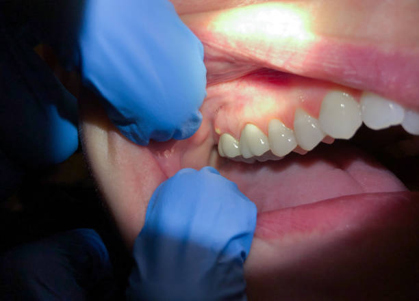 Best Dental Abscess Treatment in Howland Center, OH